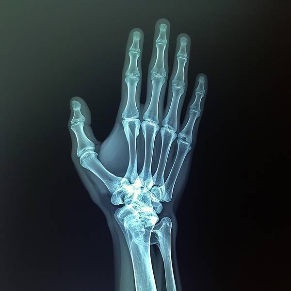 Quelle: Alana Jordan auf Pixabay Eine Hand im Röntgenbild